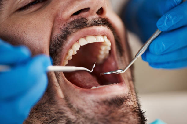 Best Emergency Wisdom Teeth Removal in Morse, LA